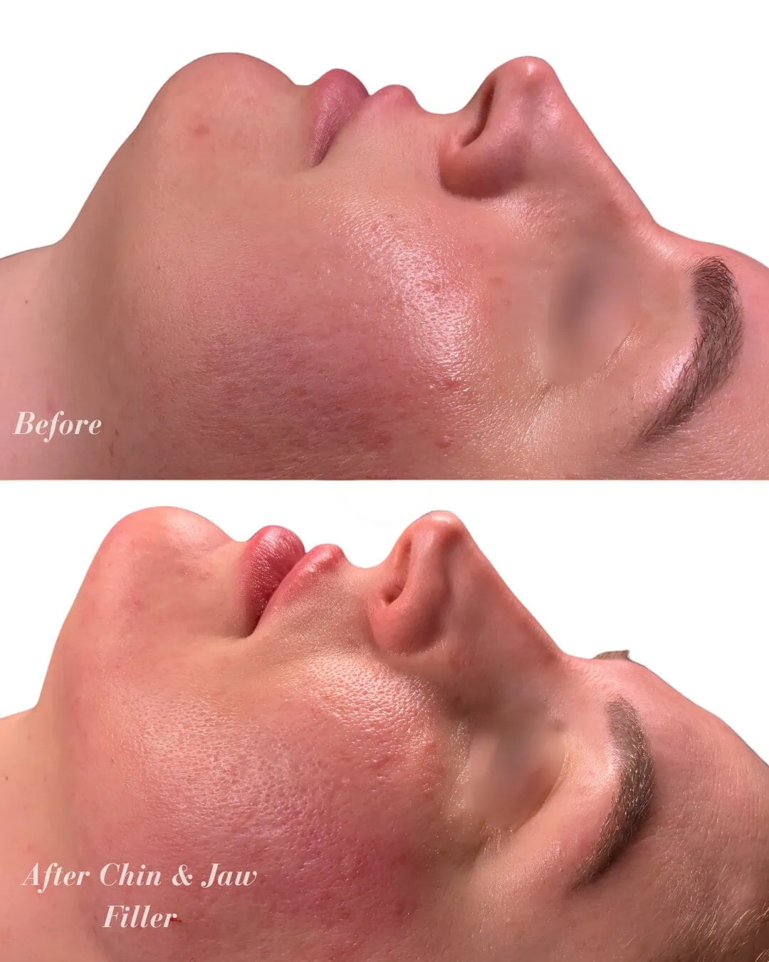 Before and After Chin and Jaw Filer
