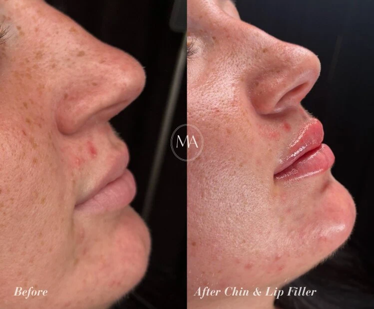 Before and After Chin and Lip Filler