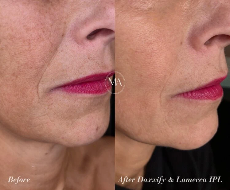 Before and After Daxxify and LumeccaIPL