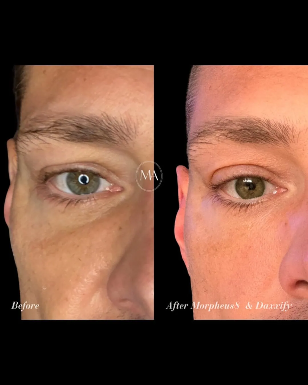 Before and After Daxxify and Morpheus 8 b