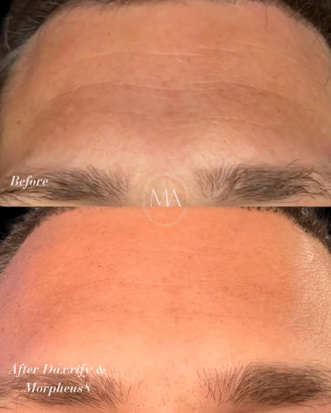 Before and After Daxxify and Morpheus 8