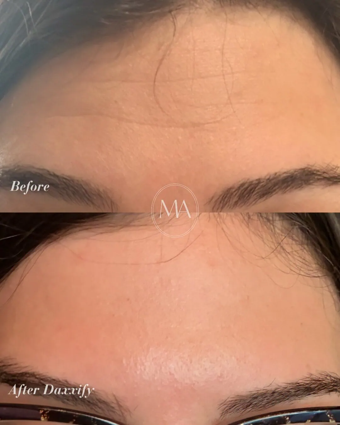 Before and After Daxxify