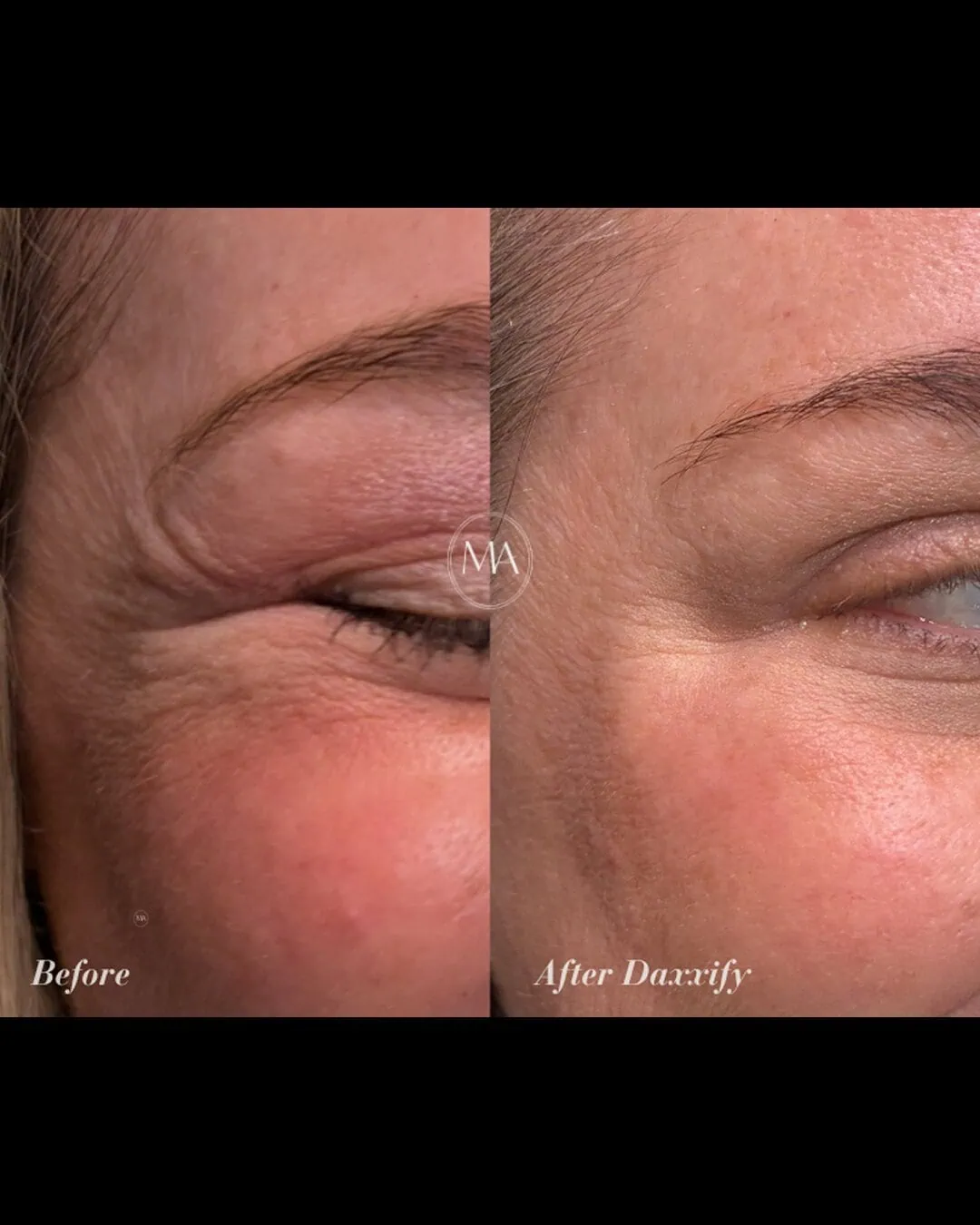 Before and After Daxxify c