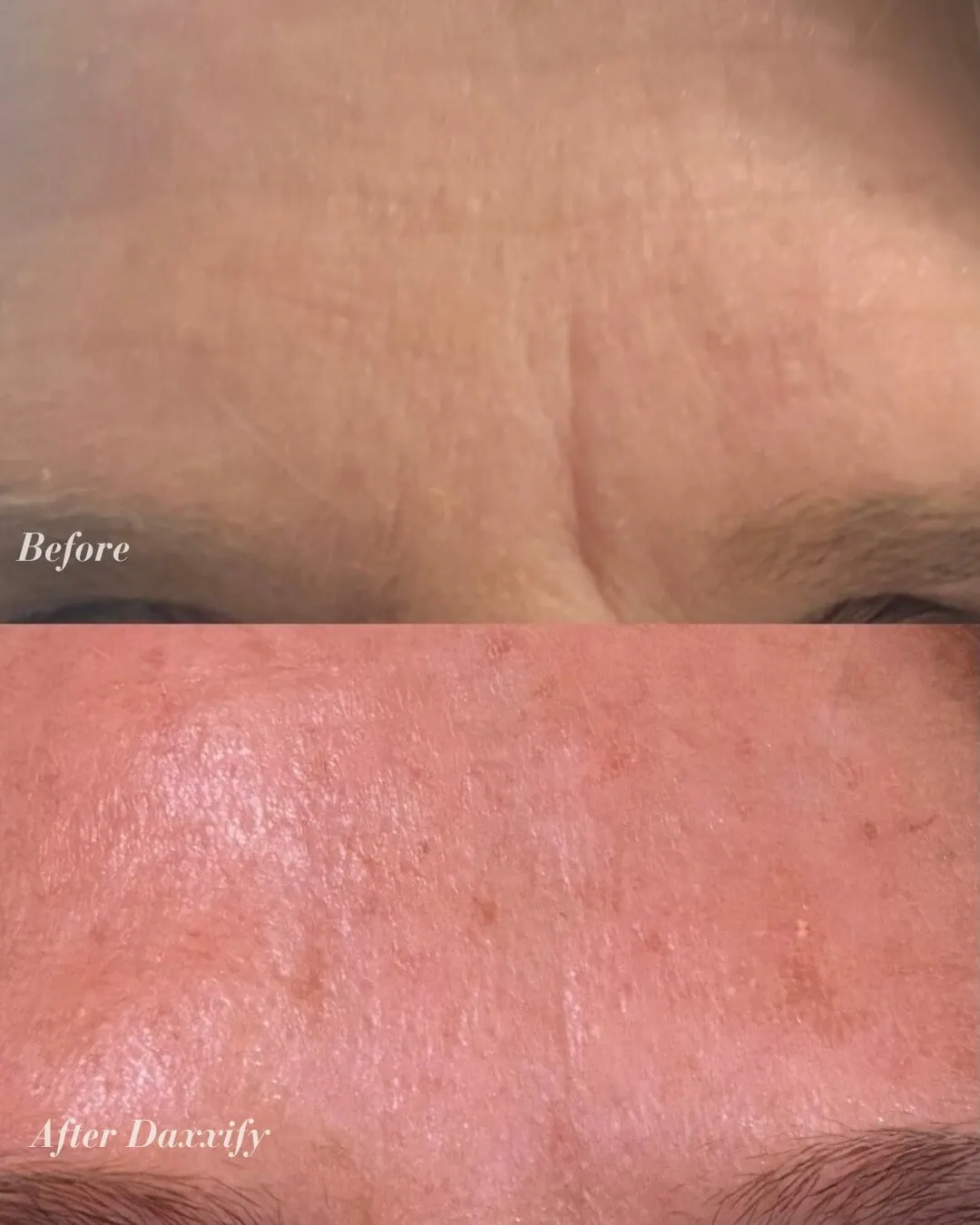 Before and After Daxxify