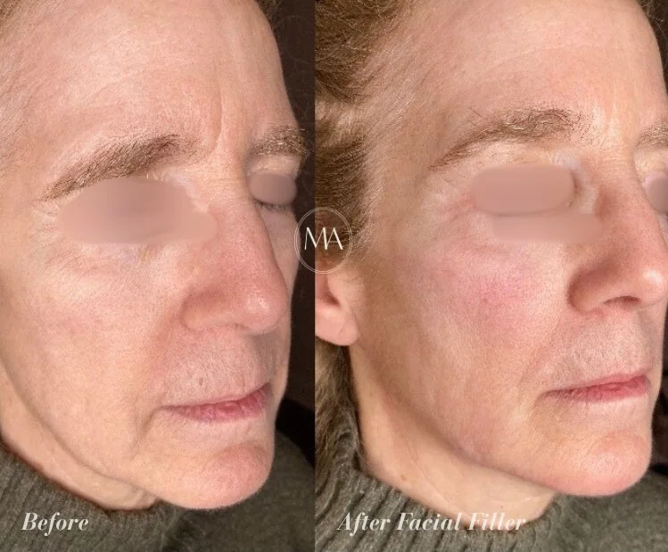 Before and After Facial Filler