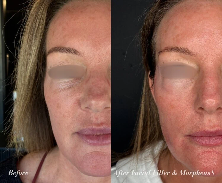 Before and After Facial Filler and Morpheus8