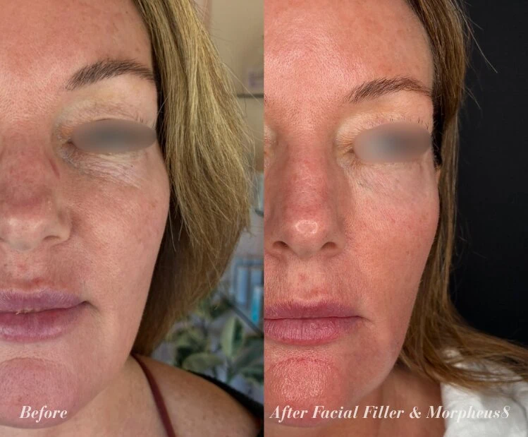 Before and After Facial Filler and Morpheus8