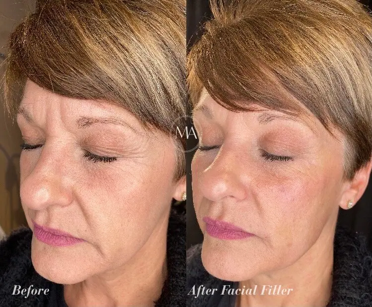 Before and After Facial Filler
