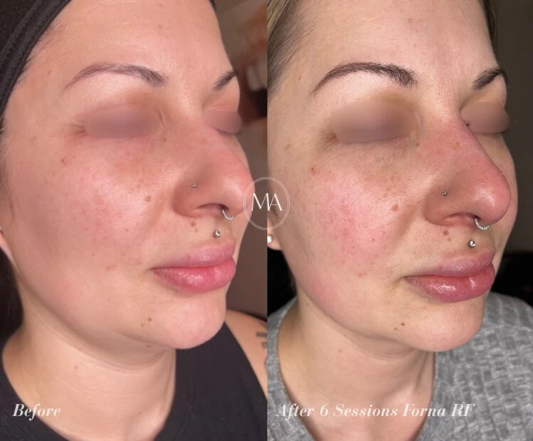 Before and After Forma RF