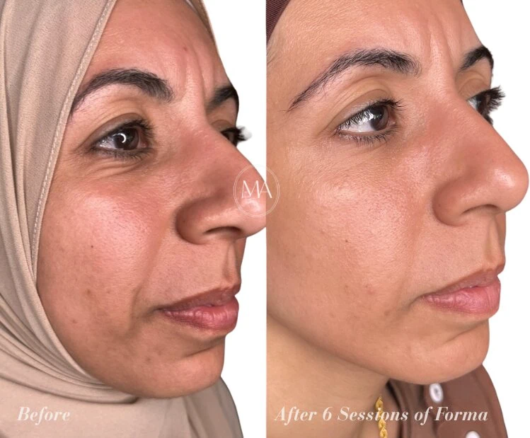 Before and After Forma