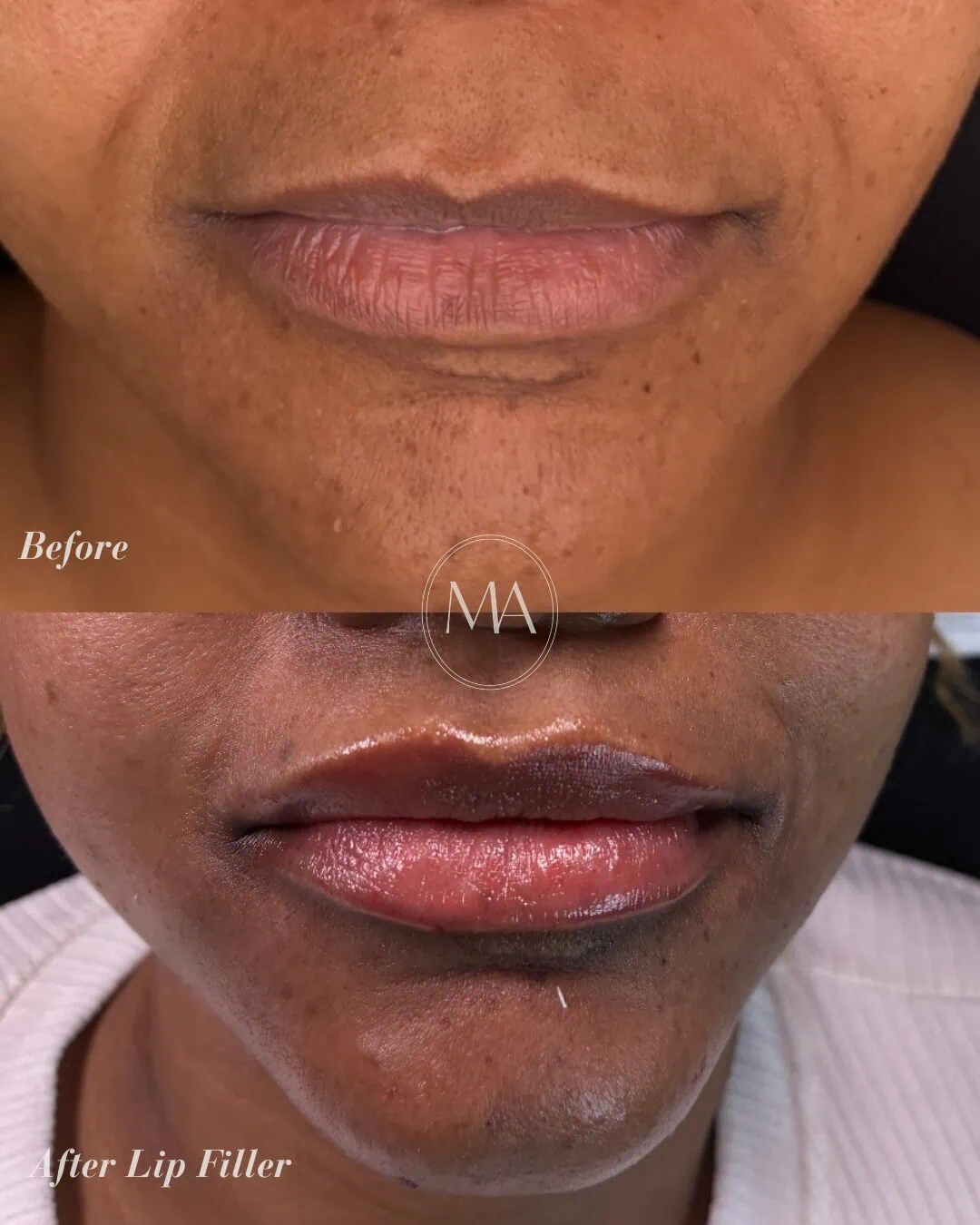 Before and After Lip Filler