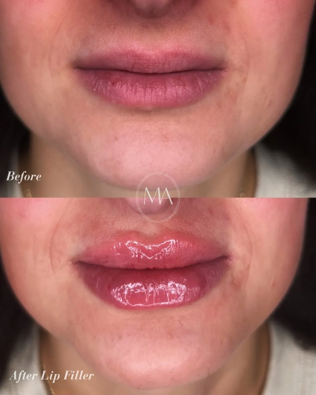 Before and After Lip Filler