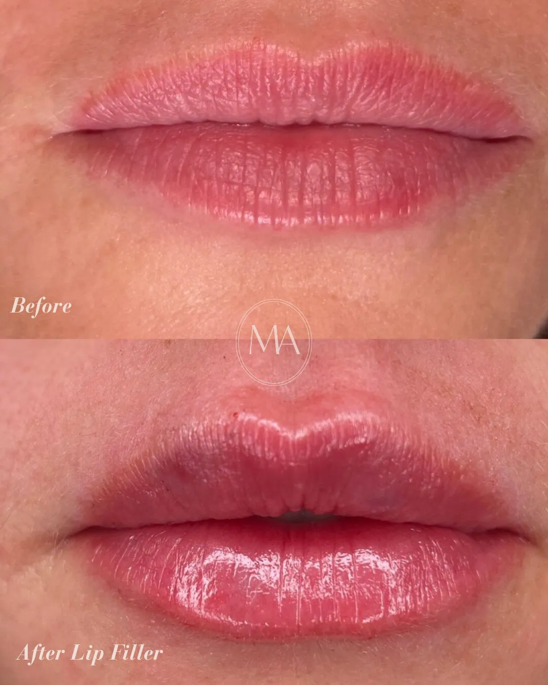 Before and After Lip Filler