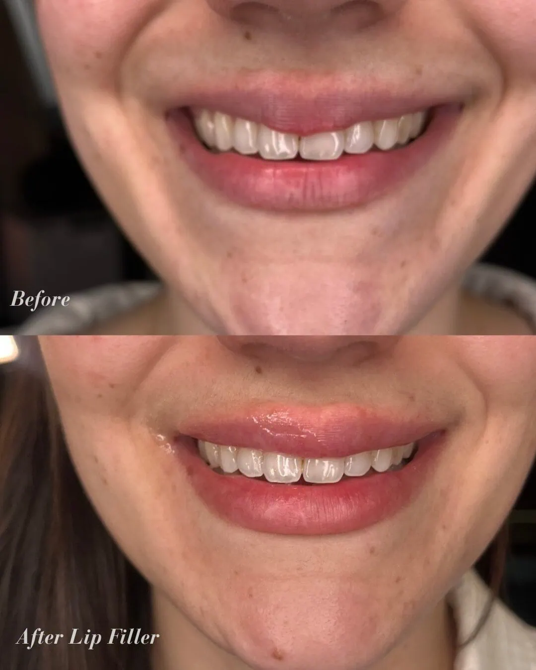 Before and After Lip Filler