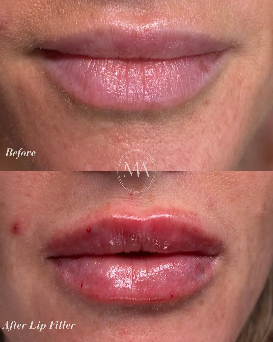 Before and After Lip Filler