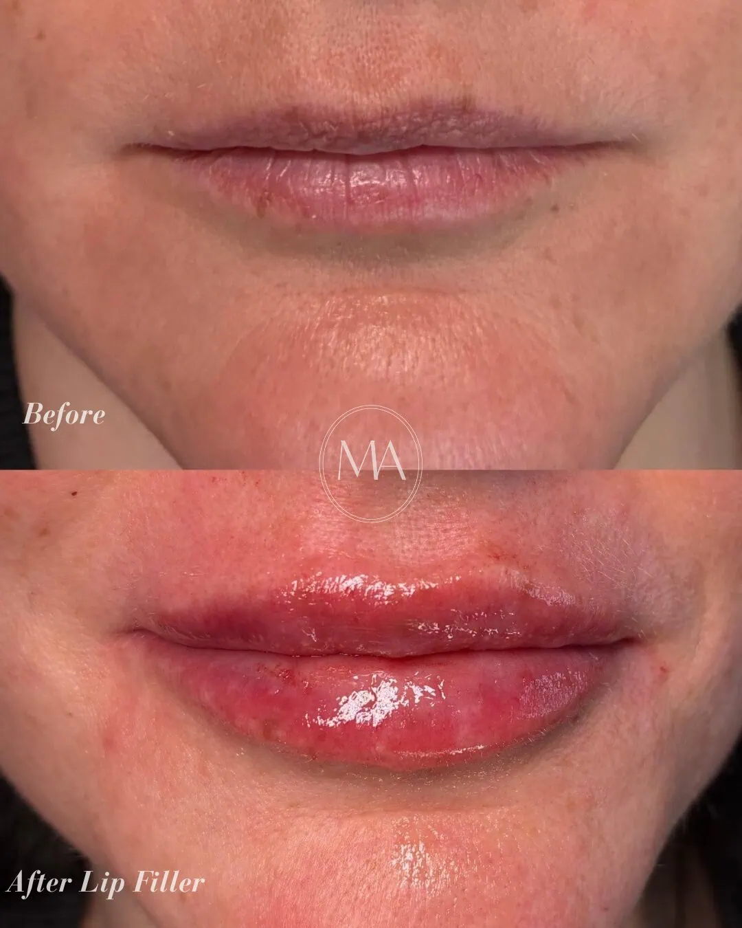 Before and After Lip Filler