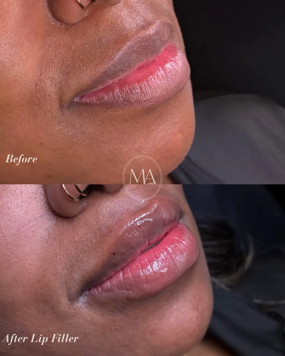 Before and After Lip Filler