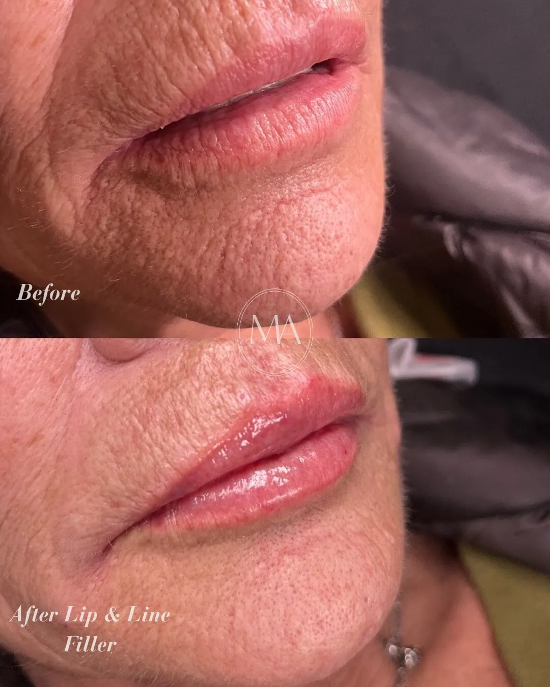 Before and After Lip Filler