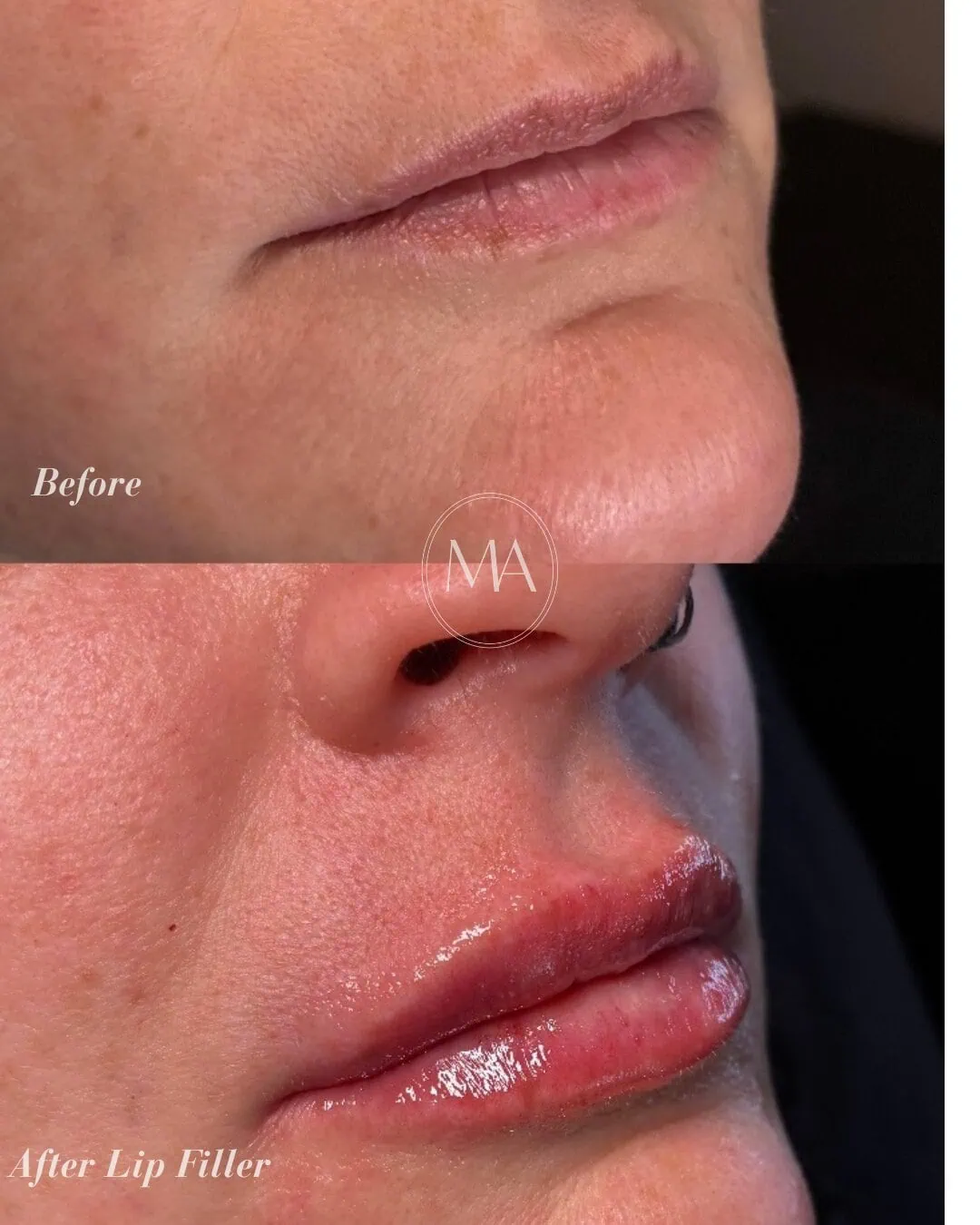 Before and After Lip Filler