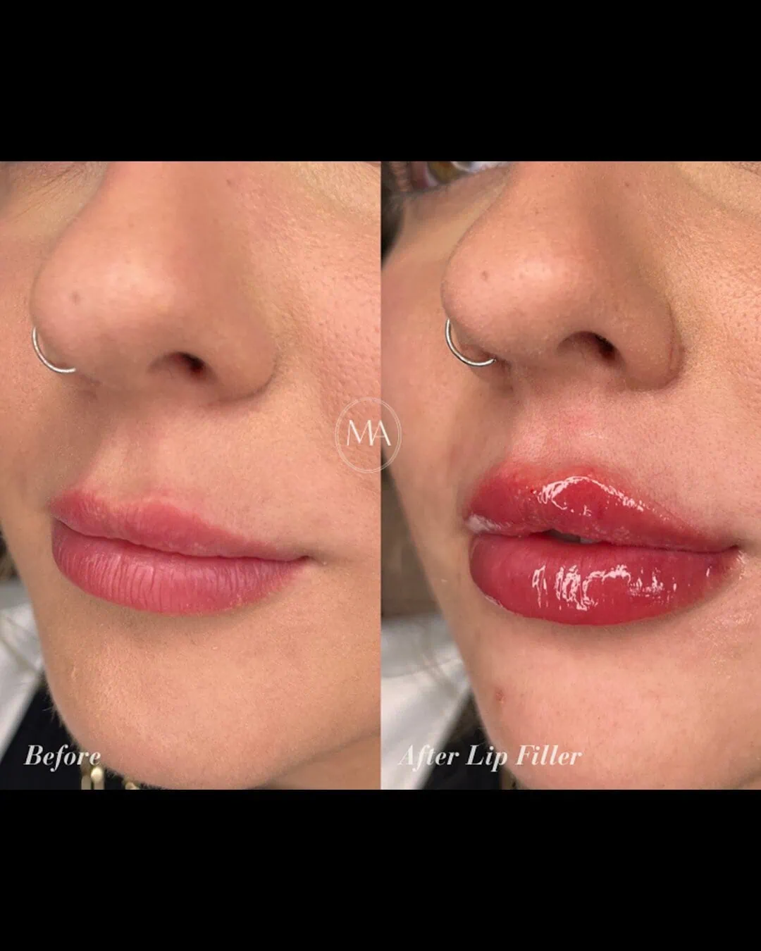 Before and After Lip Filler