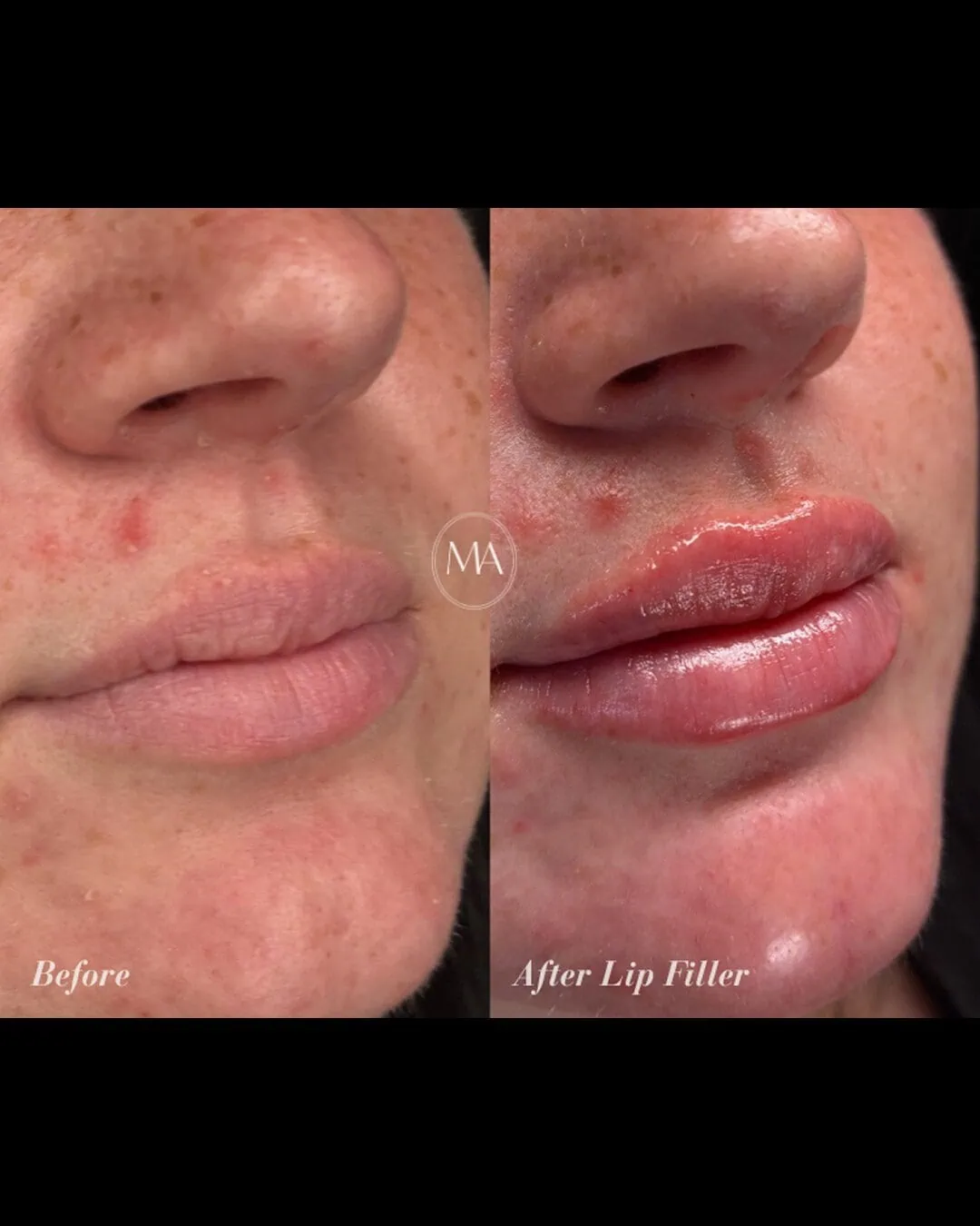 Before and After Lip Filler