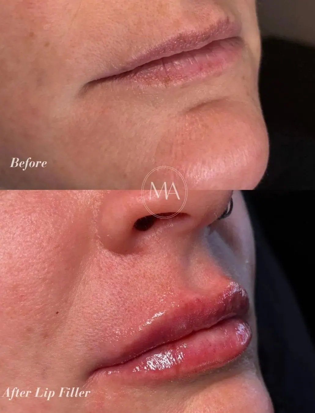 Before and After Lip Filler
