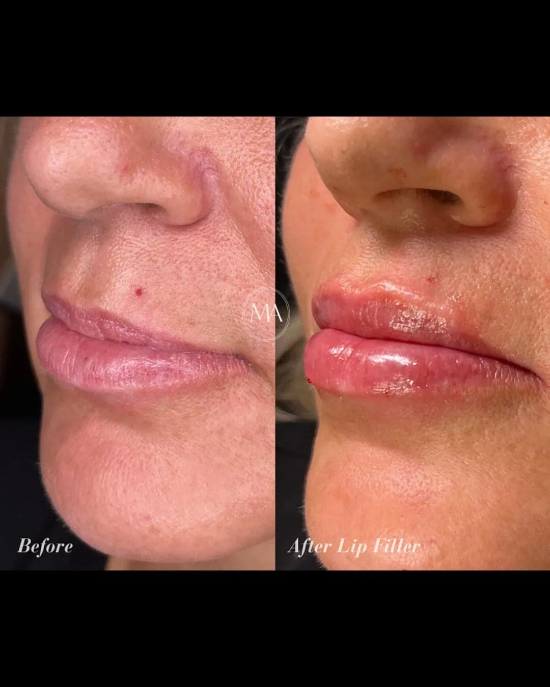Before and After Lip Filler