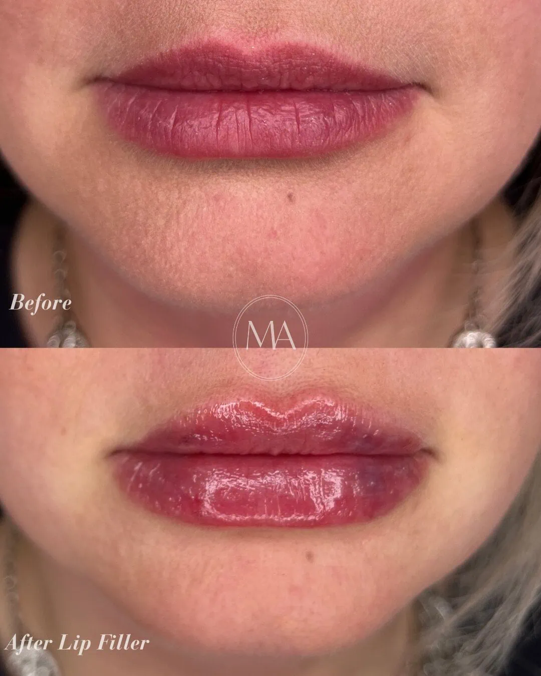 Before and After Lip Filler