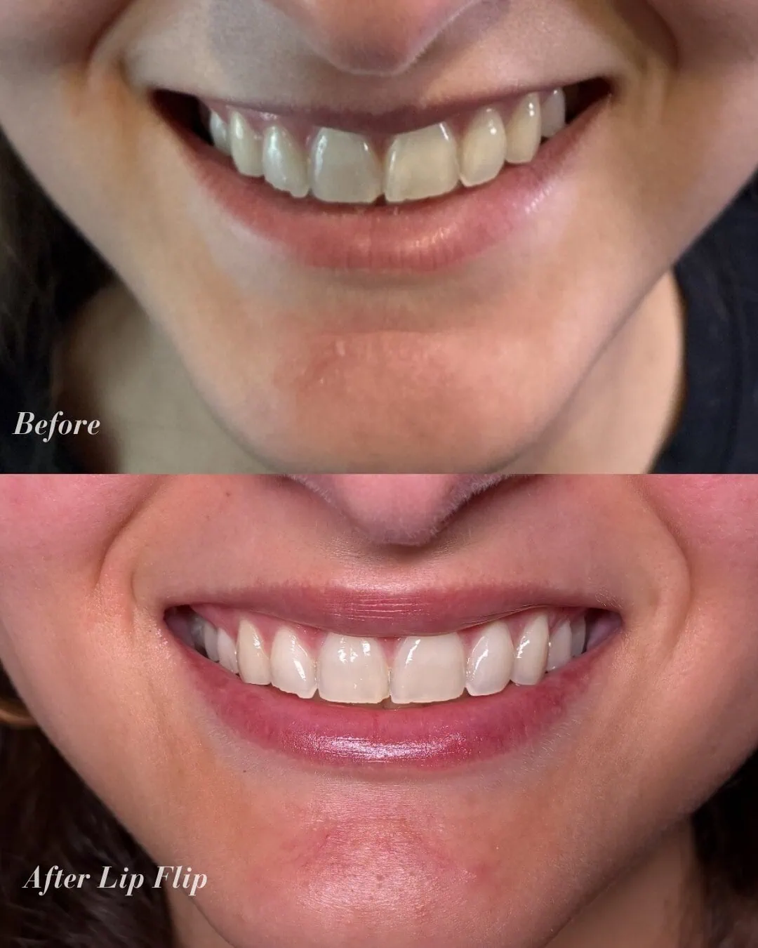 Before and After Lip Flip