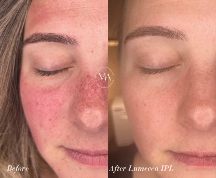 Before and After Lumecca IPL