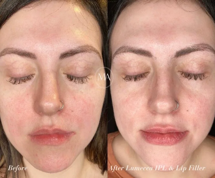 Before and After Lumecca IPL and Lip Filler