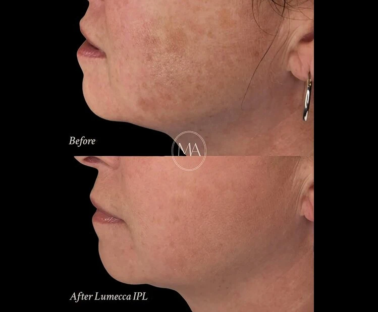 Before and After Lumecca IPL c
