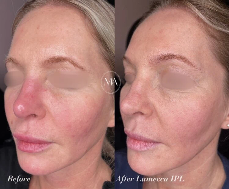 Before and After Lumecca IPL