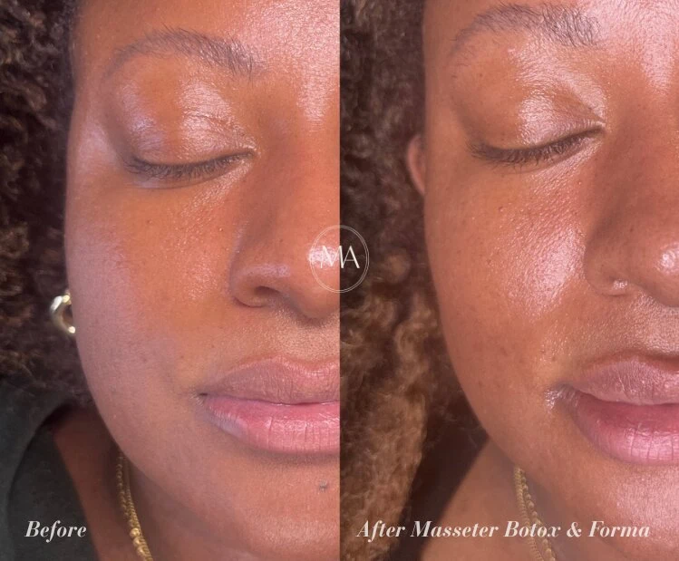 Before and After Masseter Botox and Forma