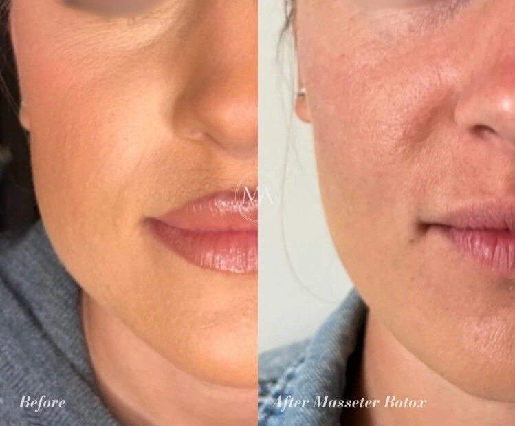 Before and After Masseter Botox