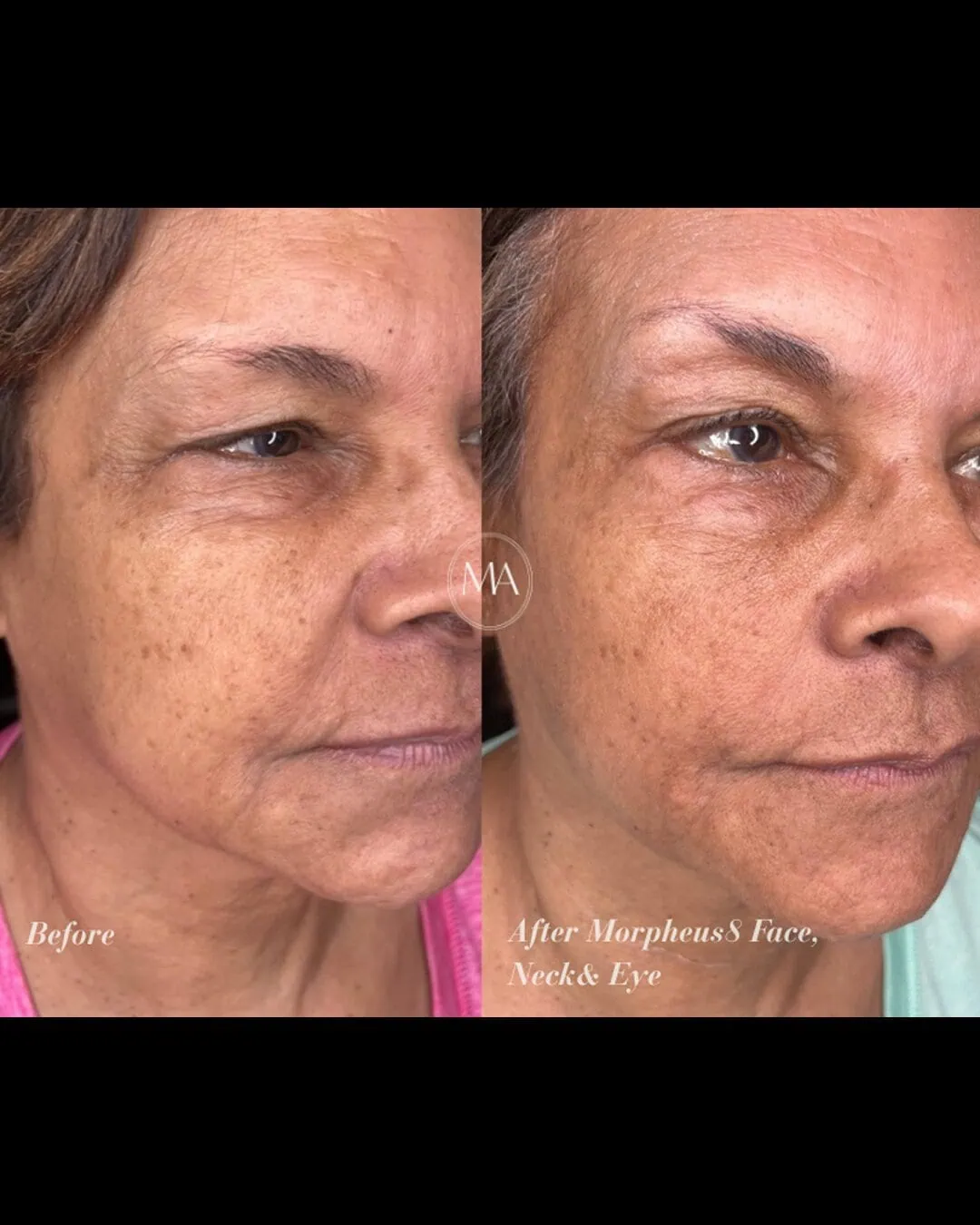 Before and After Morpheus8 face