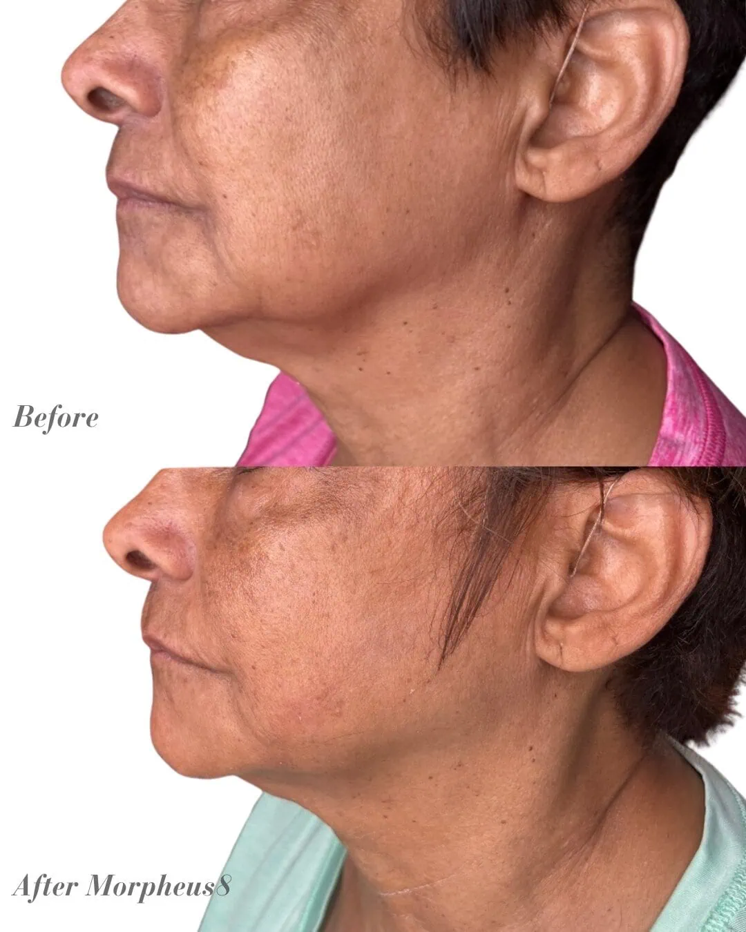 Before and After Morpheus8