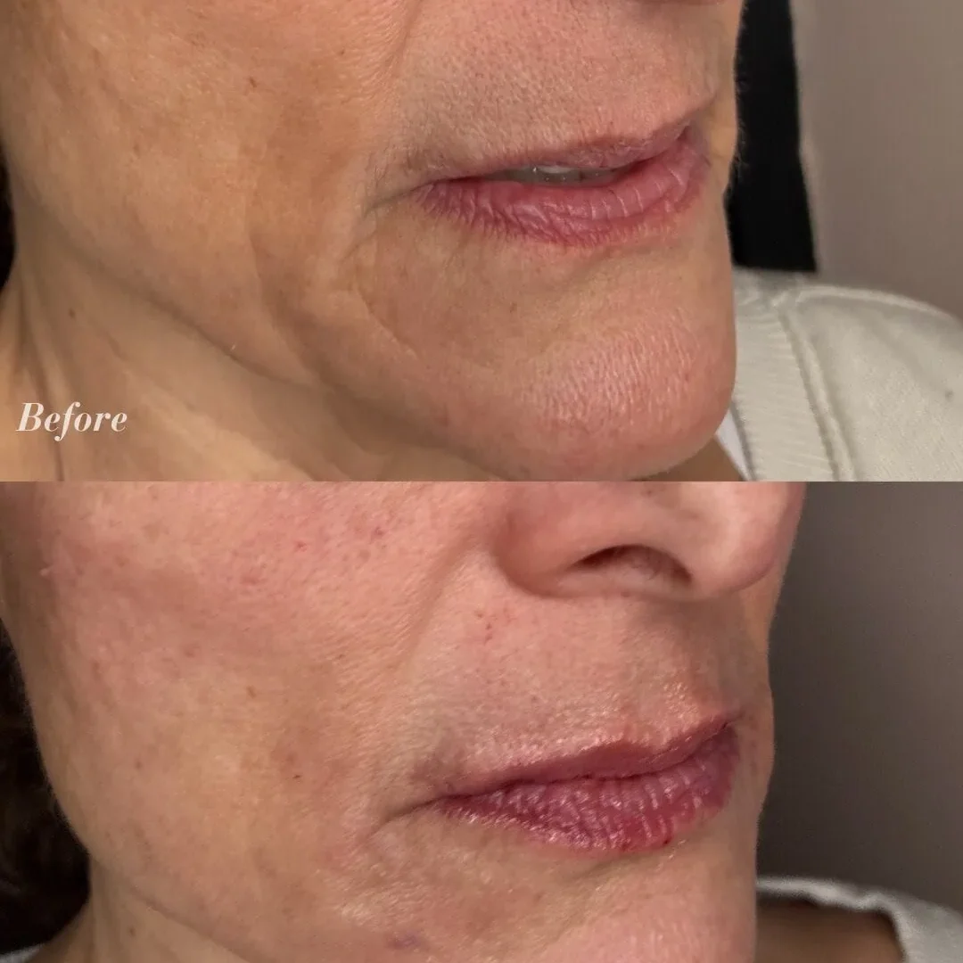 Before and After Lip and Facial Filler
