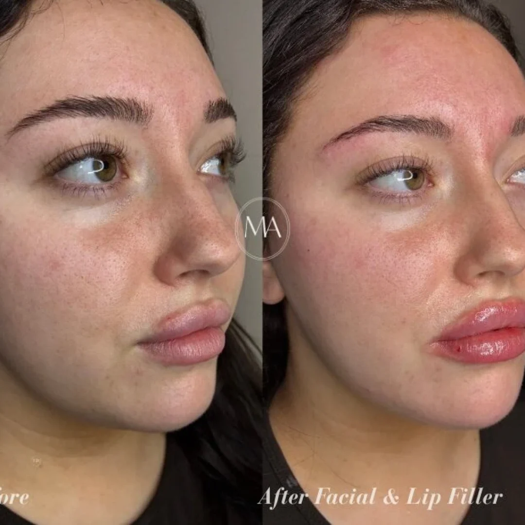 Before and After Lip and Facial Filler