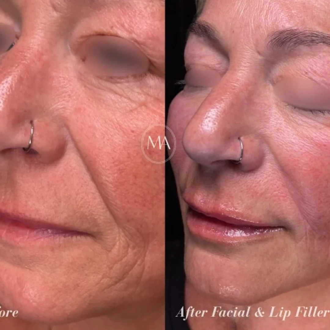 Before and After Lip and Facial Filler