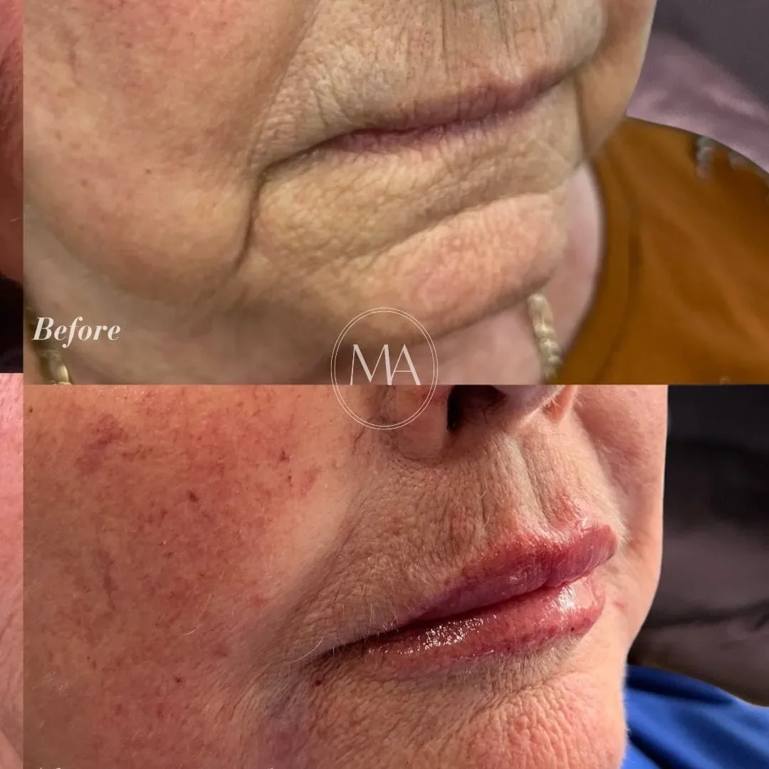 Before and After Lip and Facial Filler